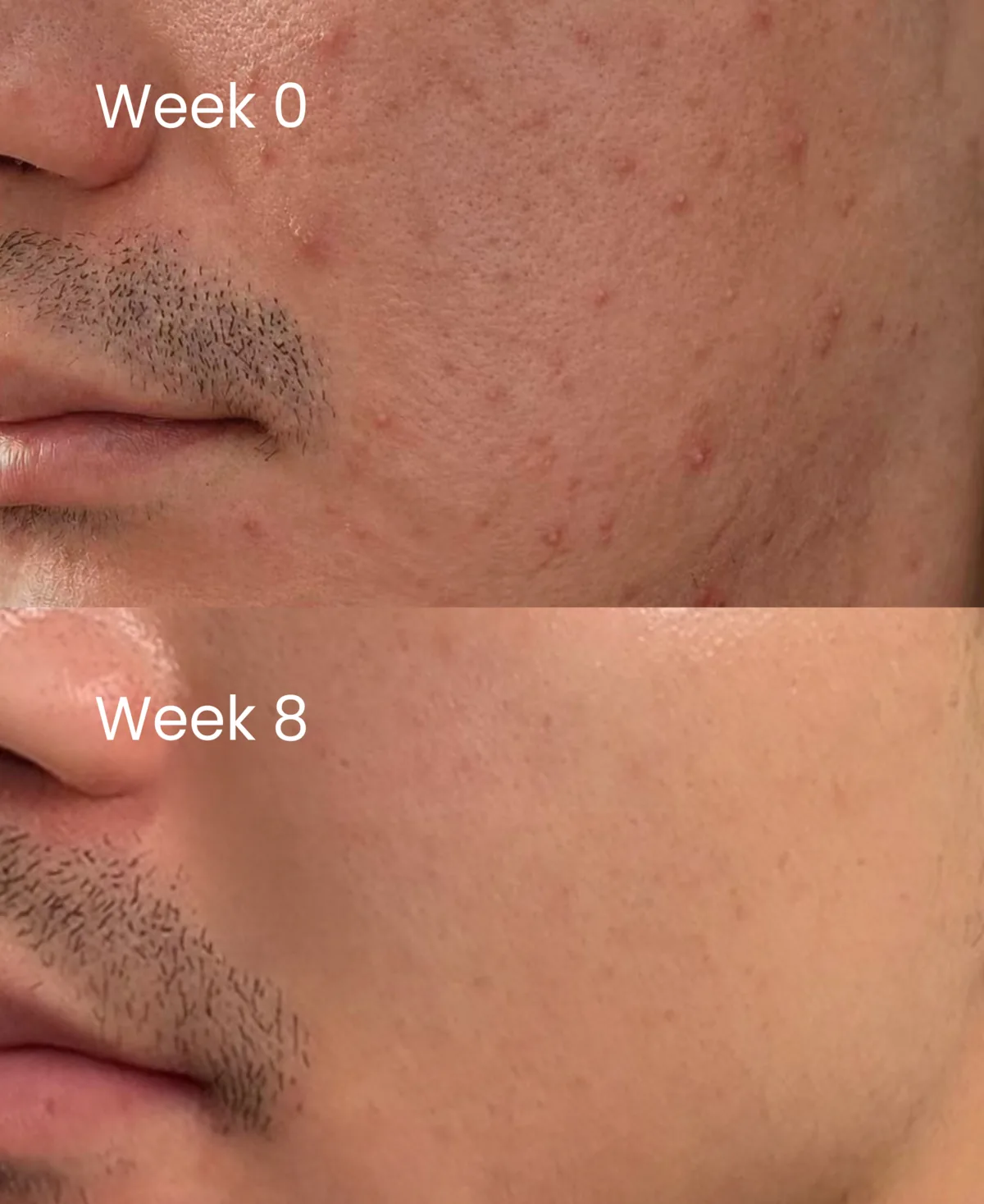 A cheek and upper lip at week 0 with widespread small breakouts, above the same area at week 8 looking clear.
