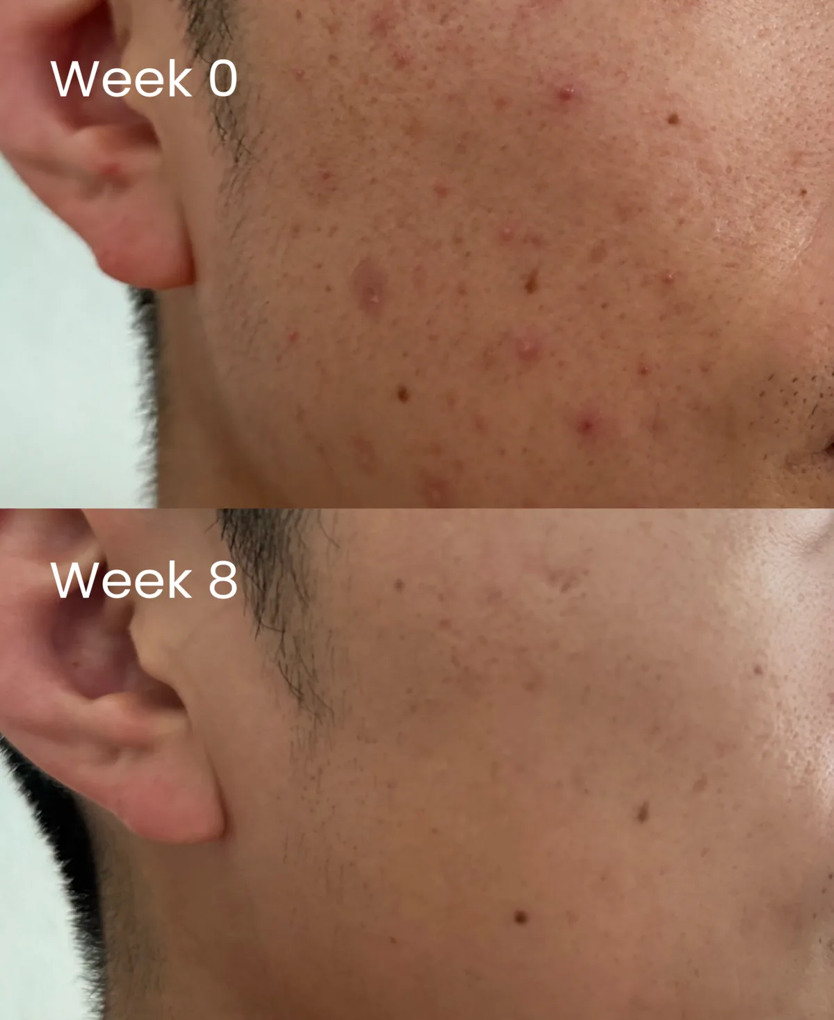 A jaw and neck at week 0 with raised inflamed spots, above the same area at week 8 with the spots resolved.