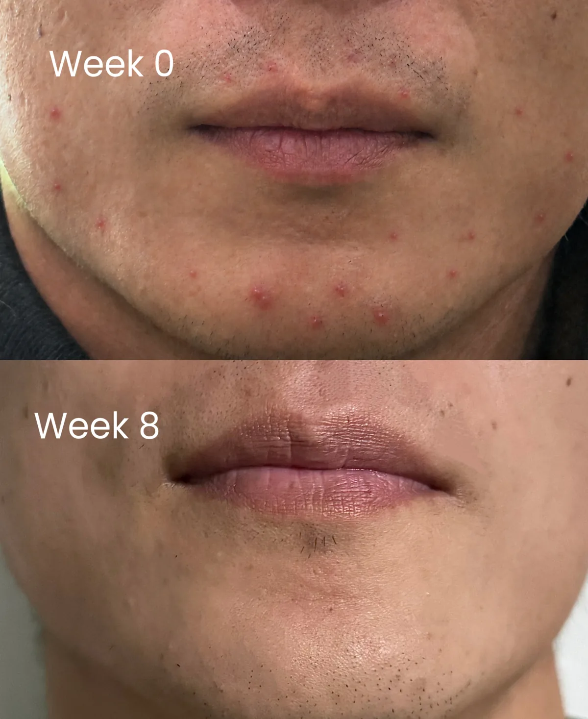 A chin and jawline at week 0 with several inflamed breakouts, above the same chin at week 8 with the breakouts resolved.