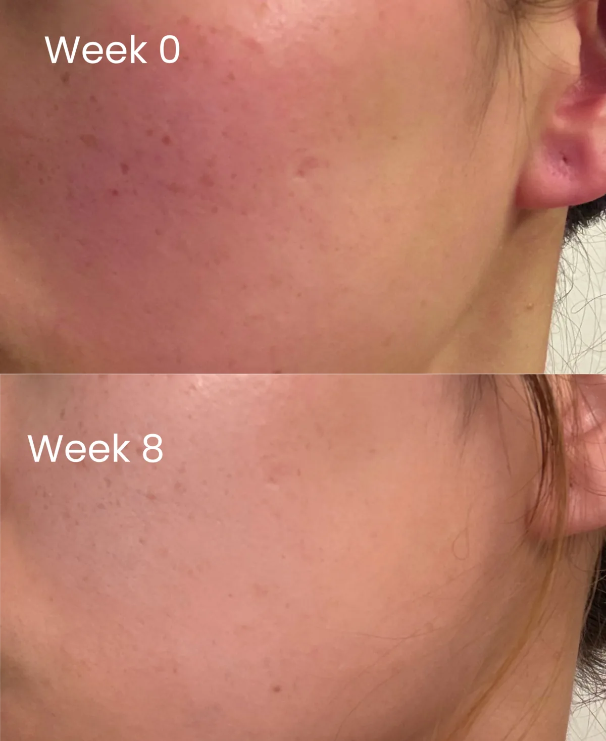 A cheek at week 0 with a flushed red patch across the cheekbone, above the same cheek at week 8 with a more even tone.