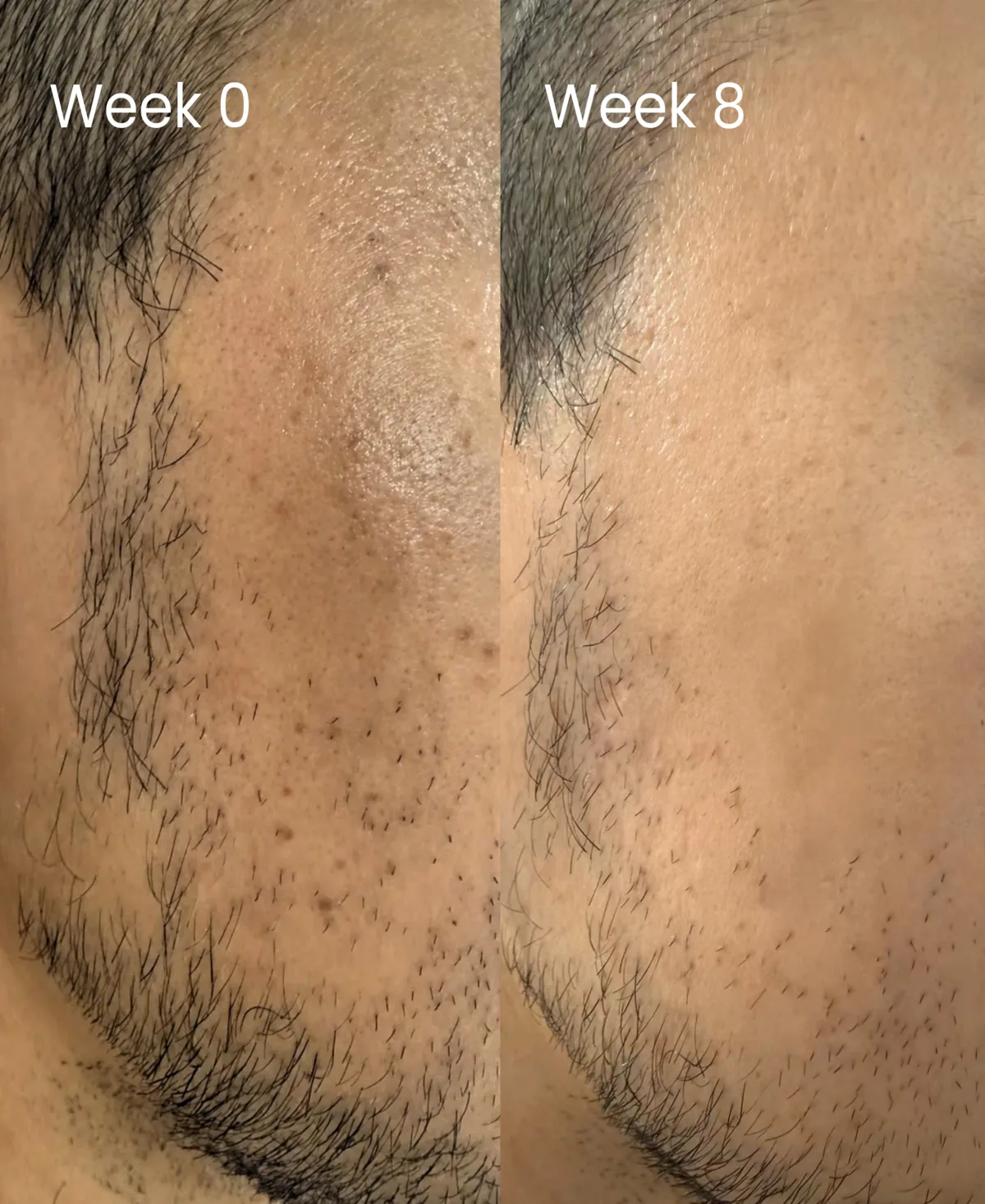 A cheek at week 0 scattered with dark marks from past breakouts, beside the same cheek at week 8 with the marks faded.