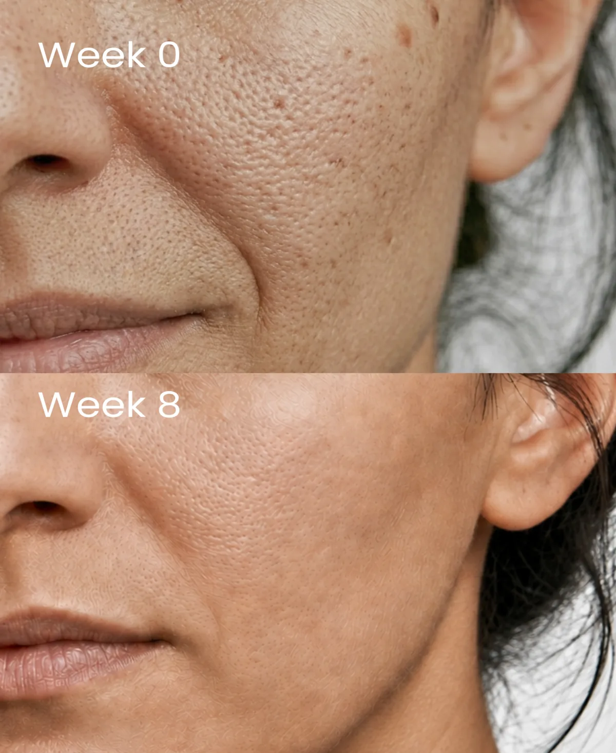 A cheek at week 0 with rough texture and visible pores, above the same cheek at week 8 looking smoother.